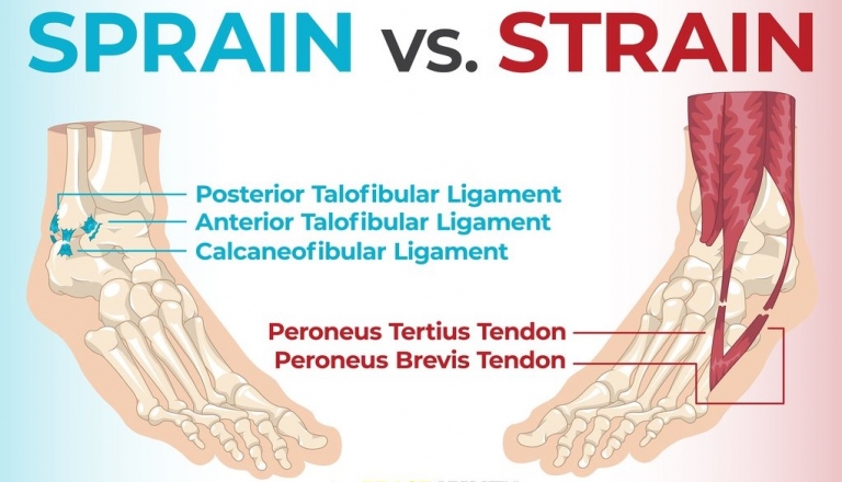 Difference between a Strain & Sprain explained - Physio Clinic Bristol